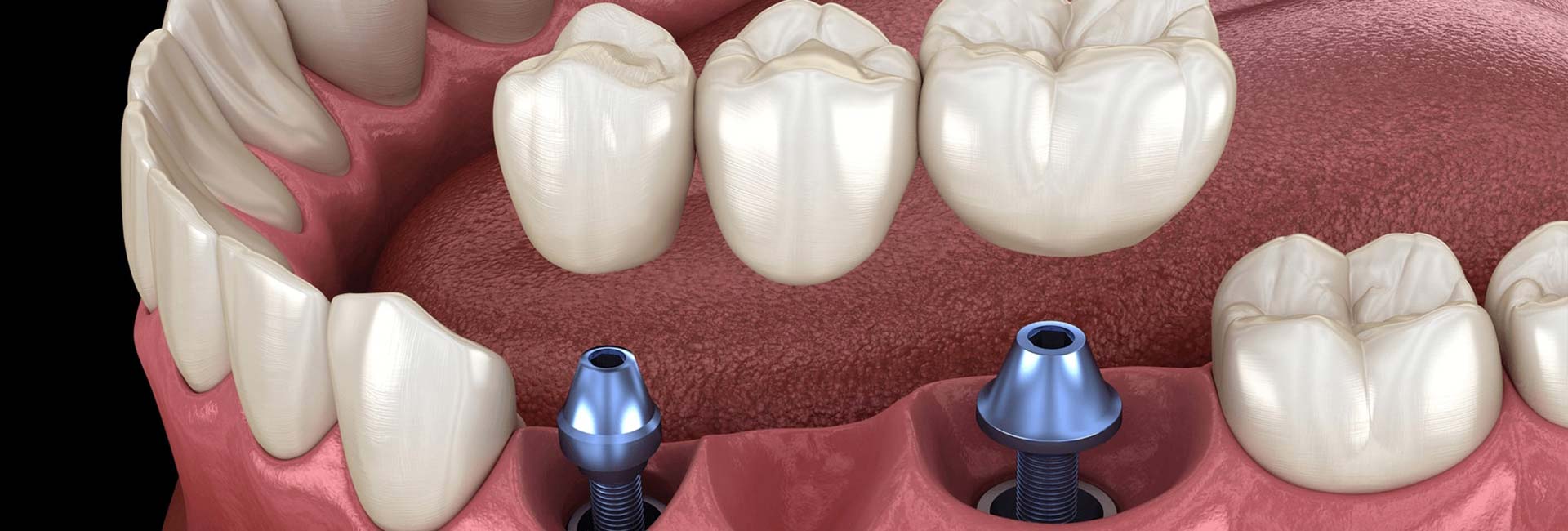 Single and multiple implant placement