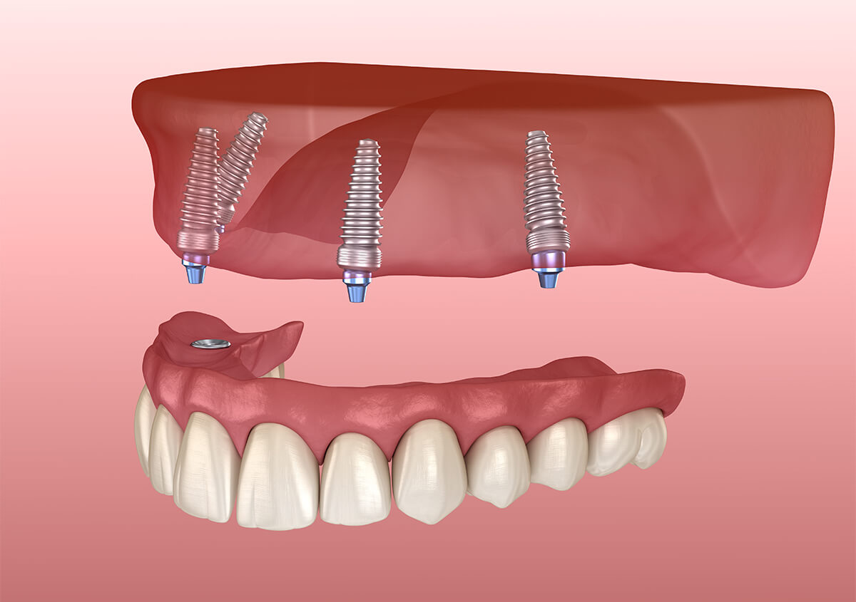 Implant Supported Dentures Service in Pensacola FL Area