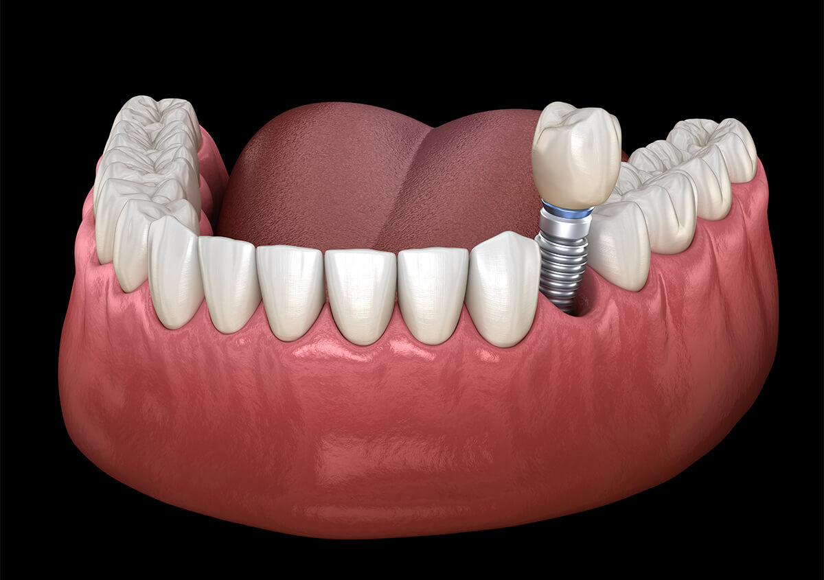 Dentist That Do Implants in Pensacola FL Area