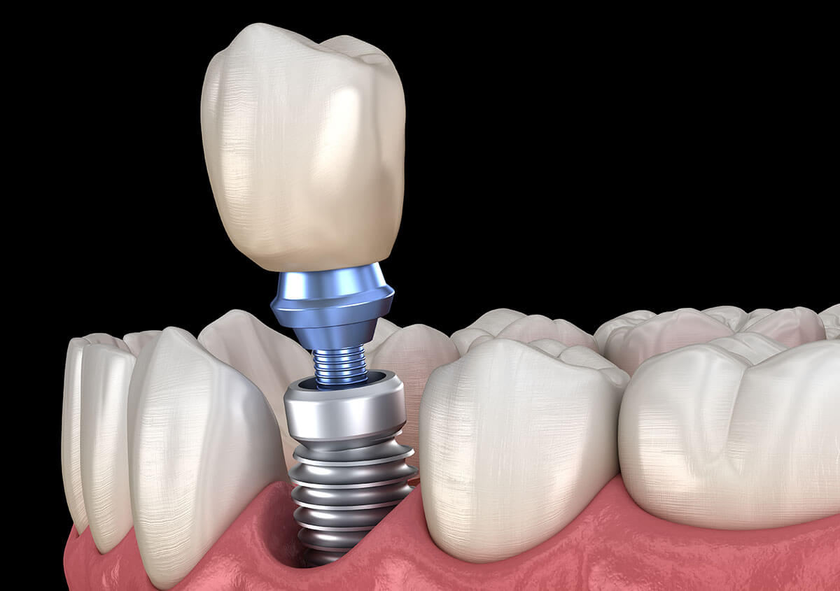 Dental Implant Procedure in Pensacola Area
